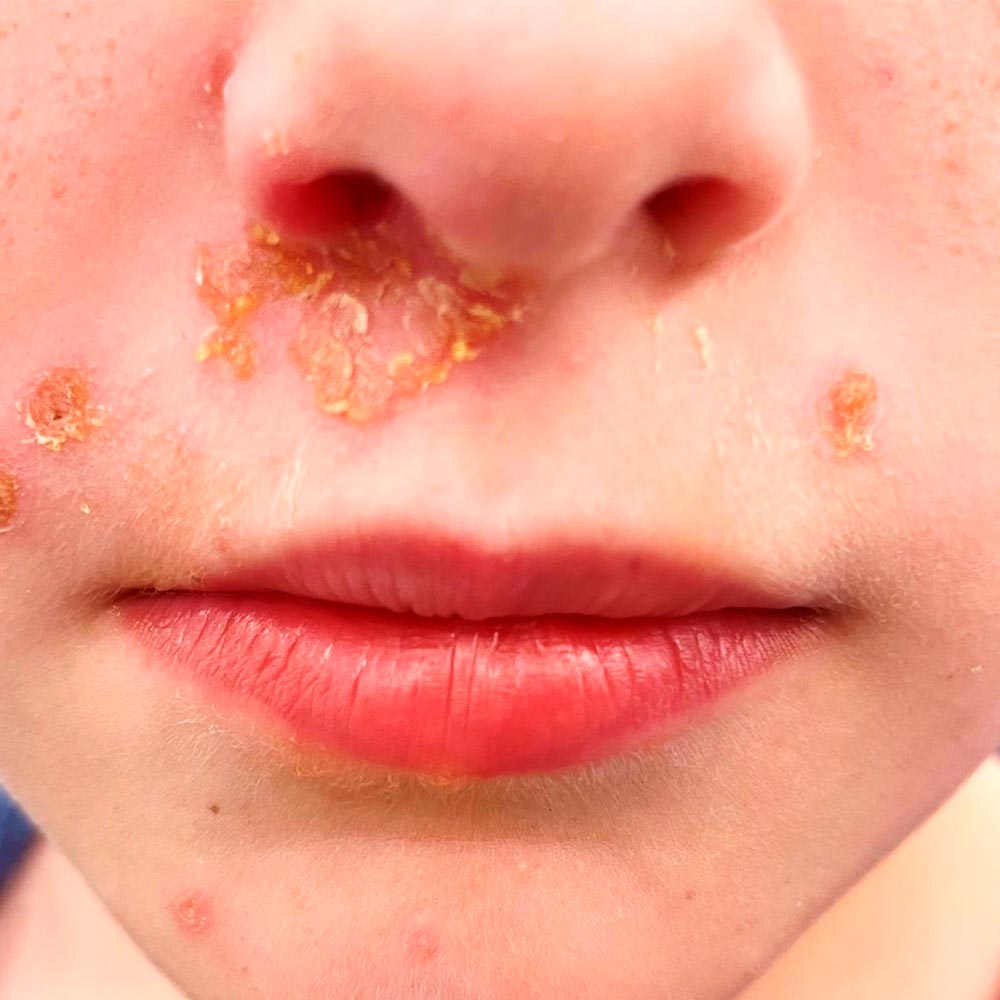 Impétigo en niños y adultos: síntomas, causas, prevención y contagio